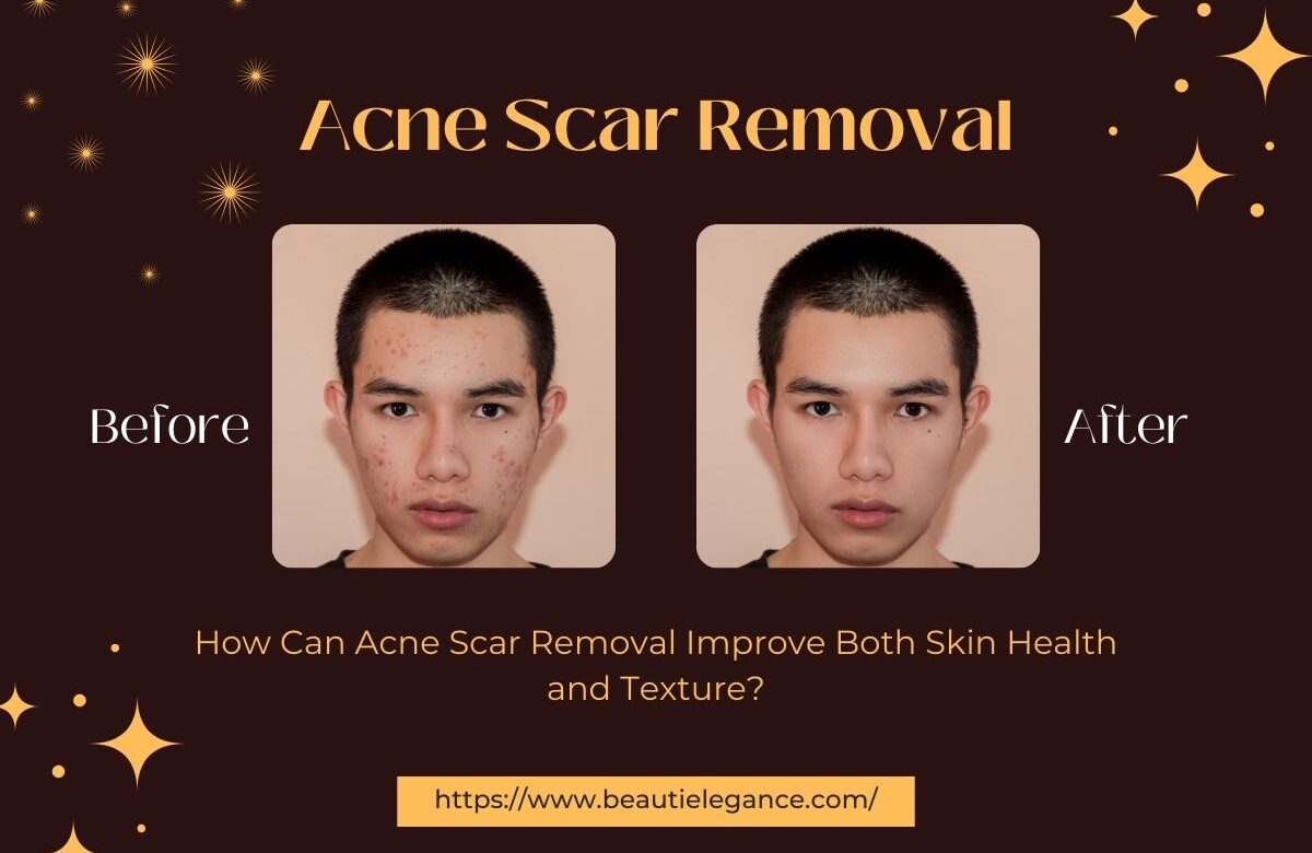 How Can Acne Scar Removal Improve Both Skin Health and Texture?