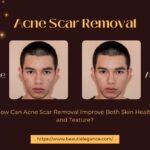 How Can Acne Scar Removal Improve Both Skin Health and Texture?