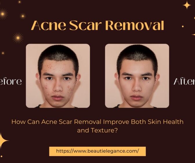 How Can Acne Scar Removal Improve Both Skin Health and Texture?